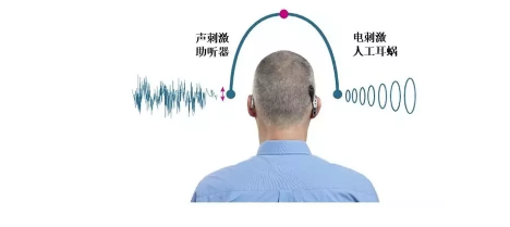 双耳双模式聆听——让听障者听得更好