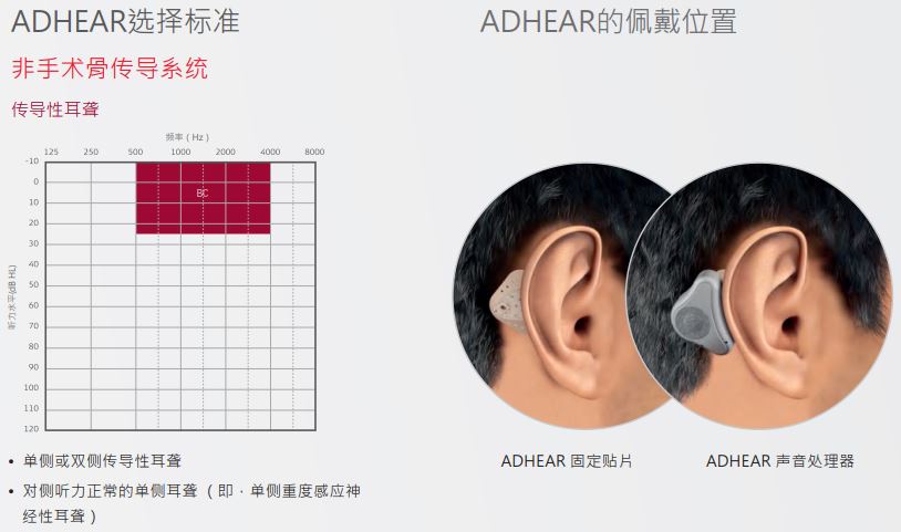 爱笛骨导助听器详细介绍和购买咨询！