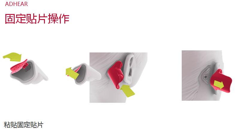 爱笛骨导助听器常见问答、使用效果与操作经验！