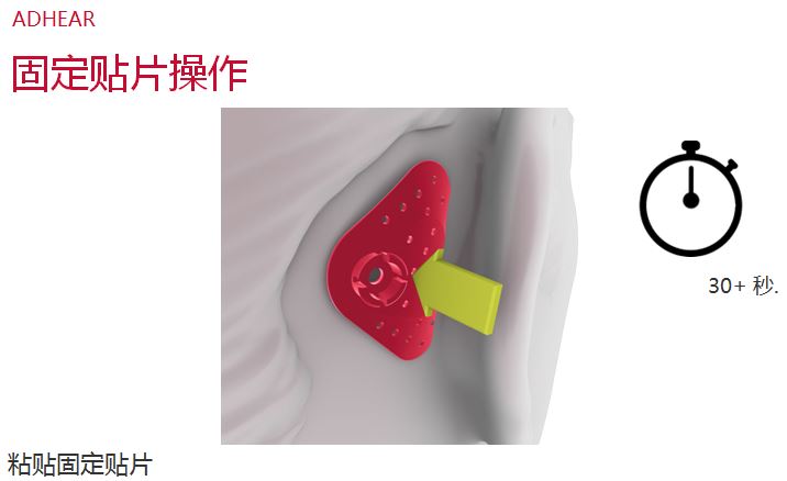 爱笛骨导助听器常见问答、使用效果与操作经验！