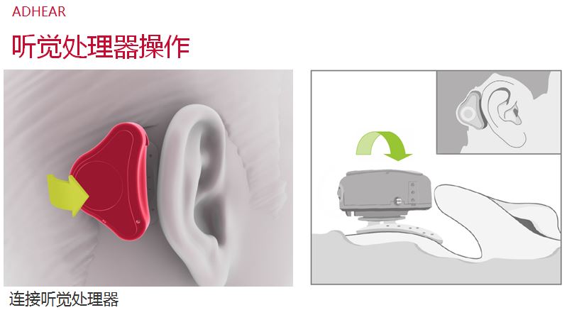 爱笛骨导助听器常见问答、使用效果与操作经验！