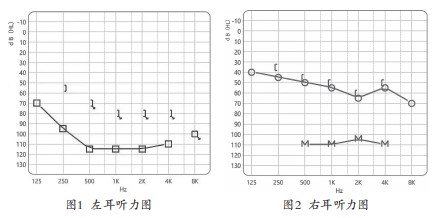 以人为本的康复理念在老年听障中的应用个案